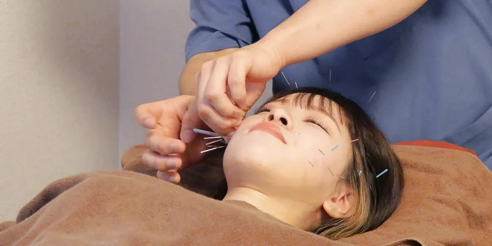 顔に鍼治療を受ける女性